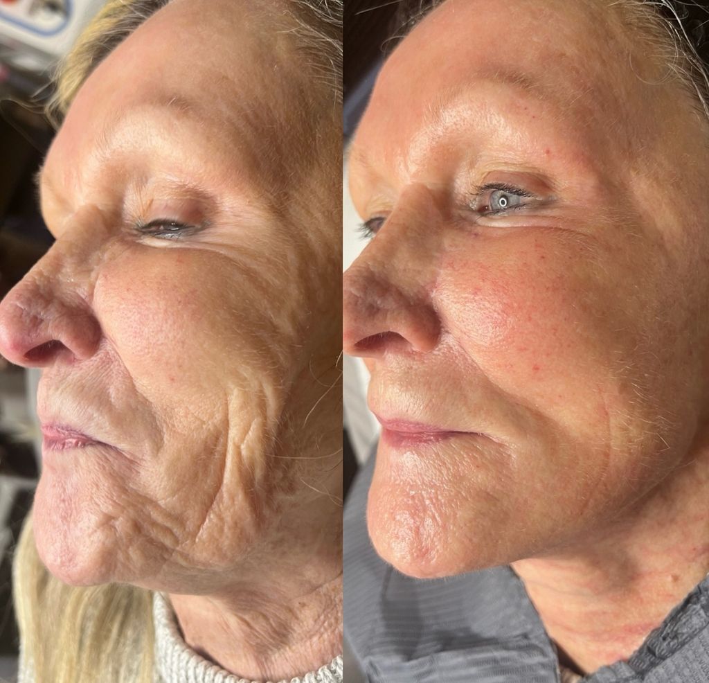 RF Microneedling for the Face